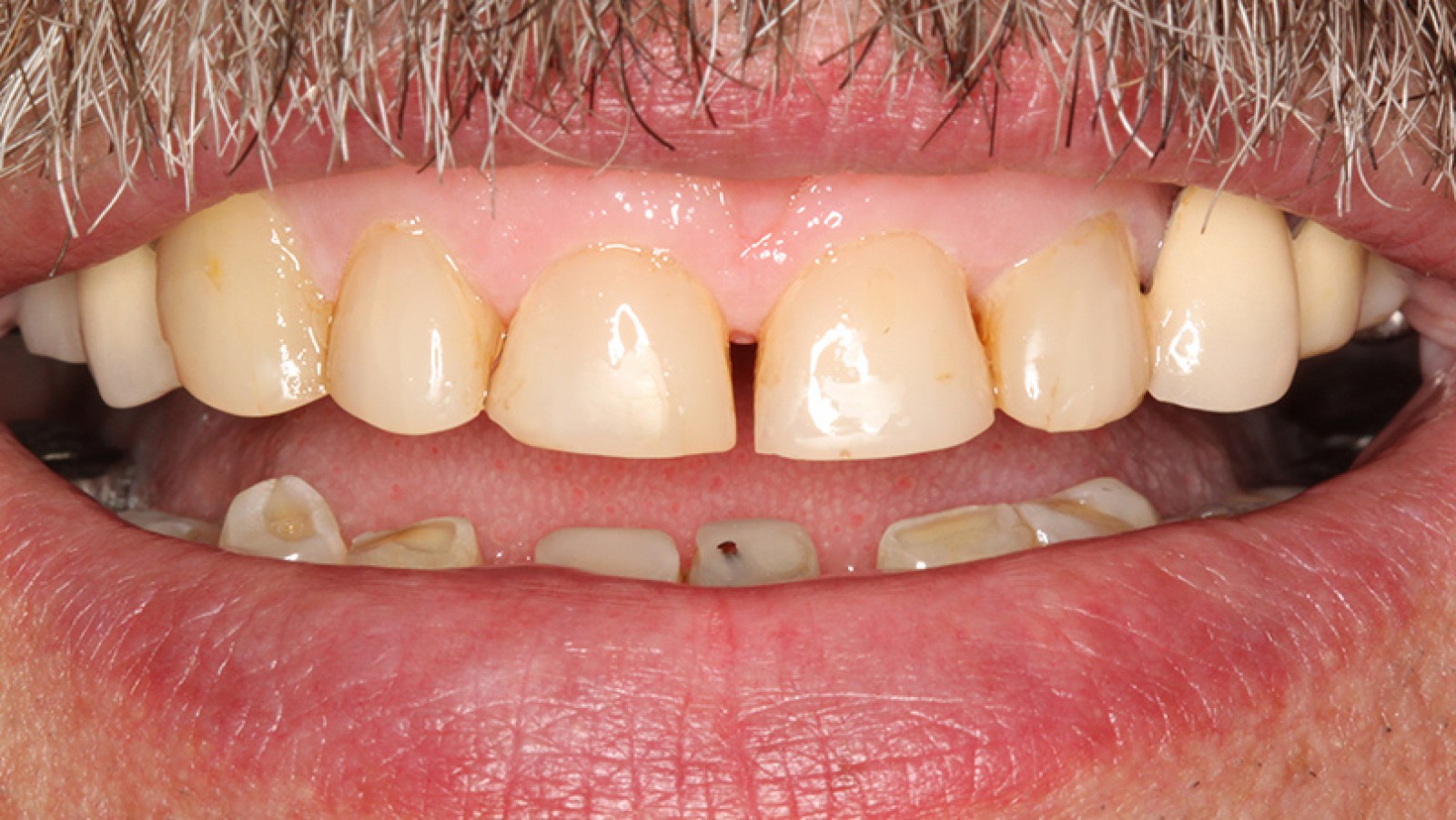 Diastema przed leczeniem 2