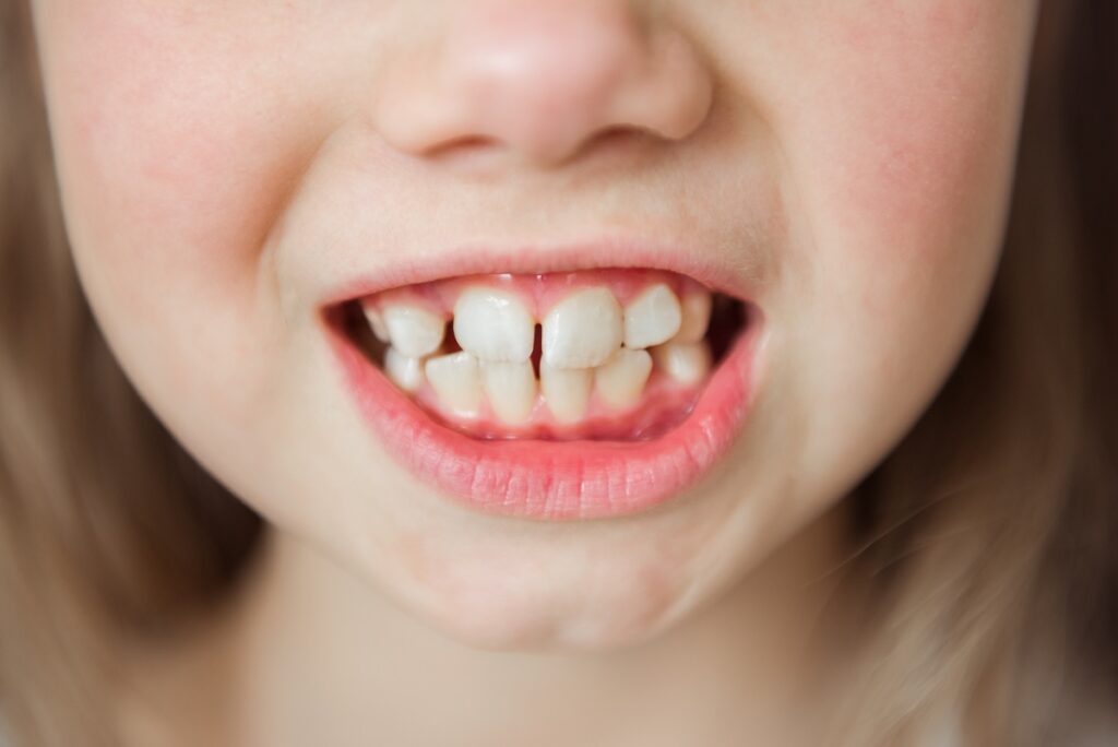 diastema u dzieci